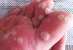 去除鸡眼视频,跟随视频教程学除法